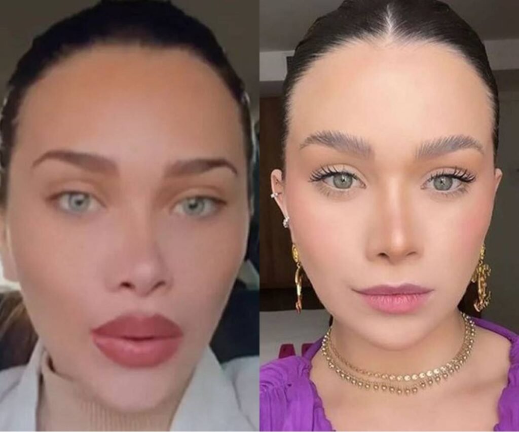 Flávia Pavanelli mostra antes e depois de remover seu preenchimento labial