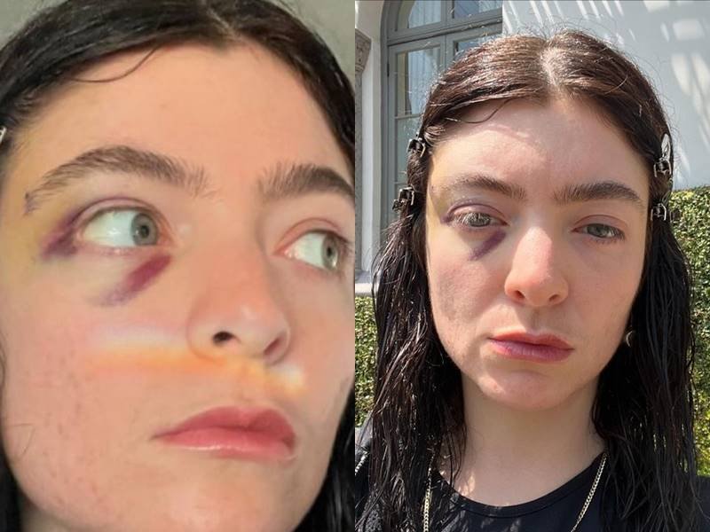 Lorde aparece com olho rosto e preocupa os fãs