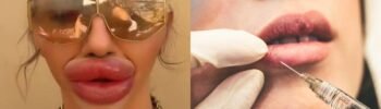 preenchimento labial