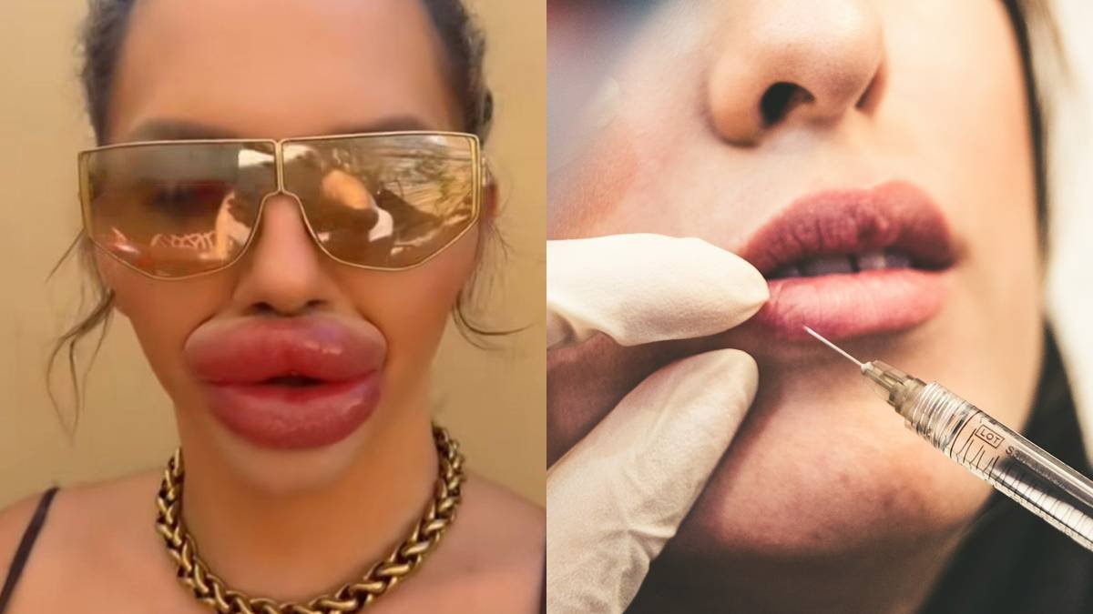 preenchimento labial